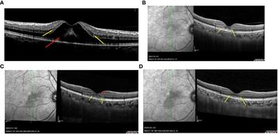 Case report: A case of Acute Macular Neuroretinopathy secondary to Influenza A virus during Long COVID